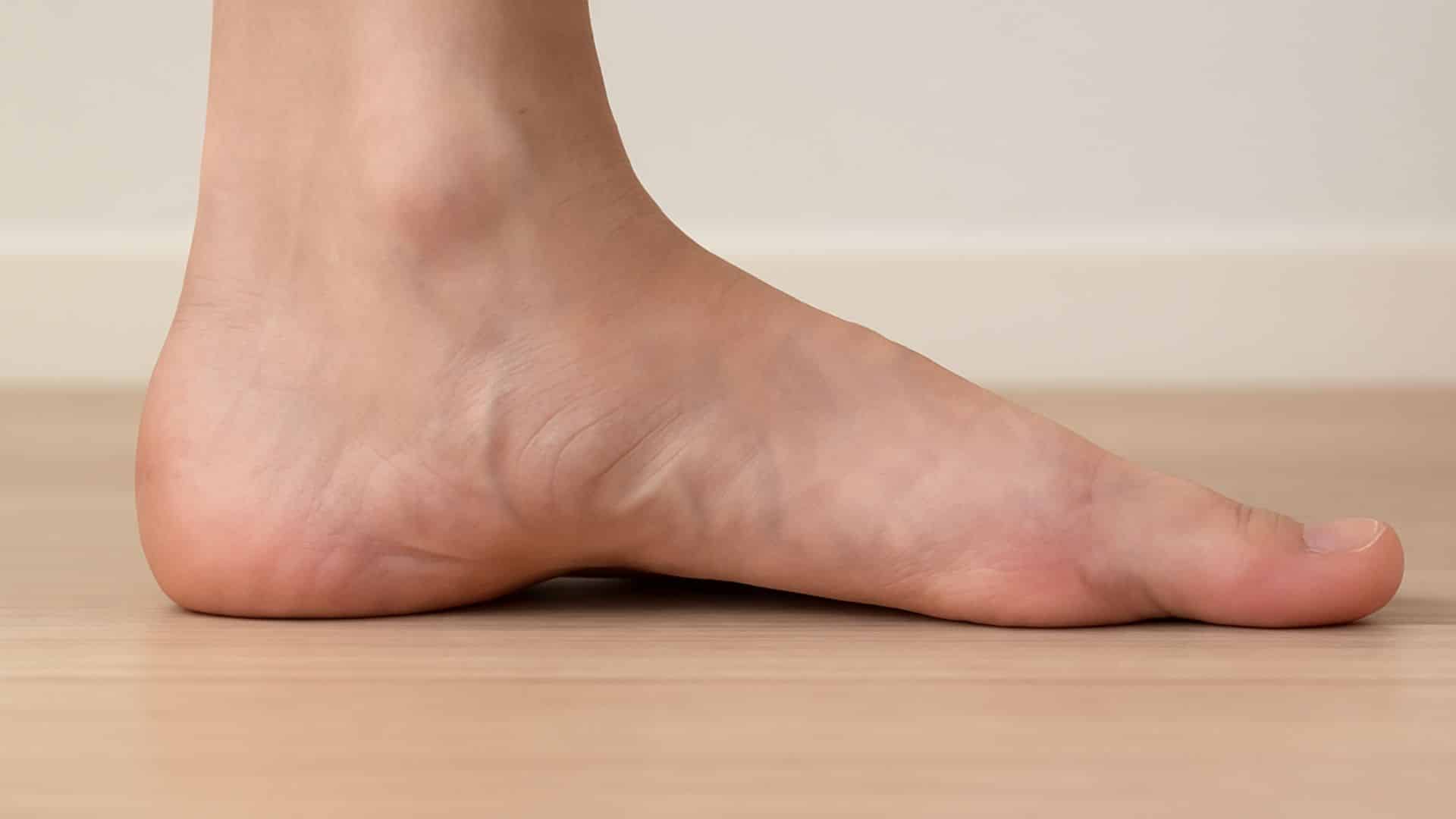 _Flat-Feet-(fallen-Arches)
