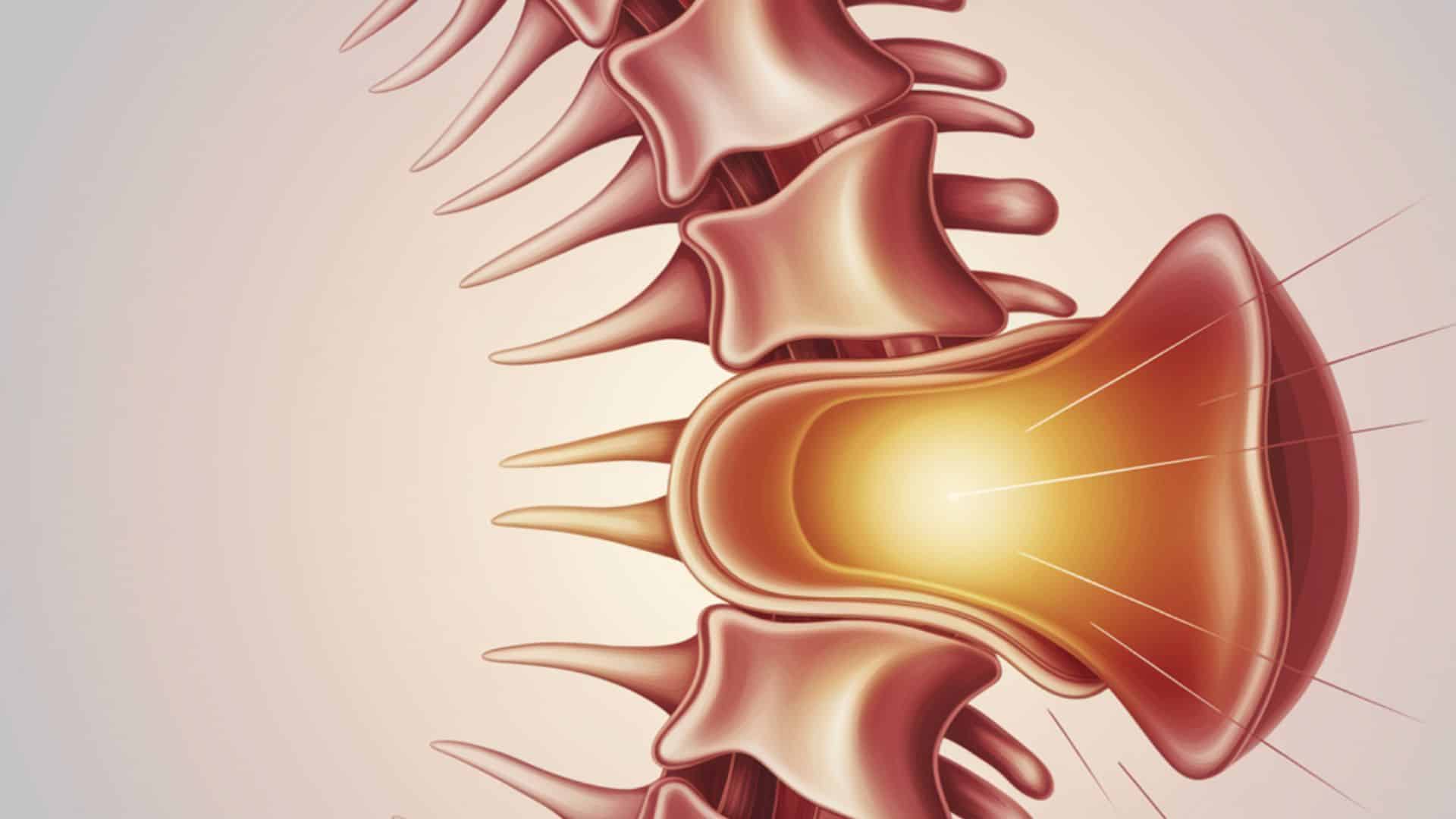 Thecal Sac Compression- A Complete Patient Guide