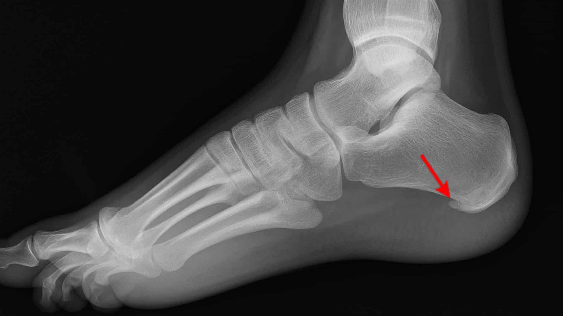 bone-spurs-on-bottom-of-feet