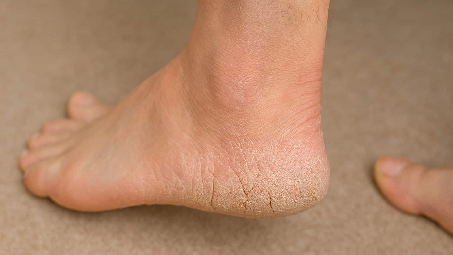 what-are-cracked-heels-a-sign-of