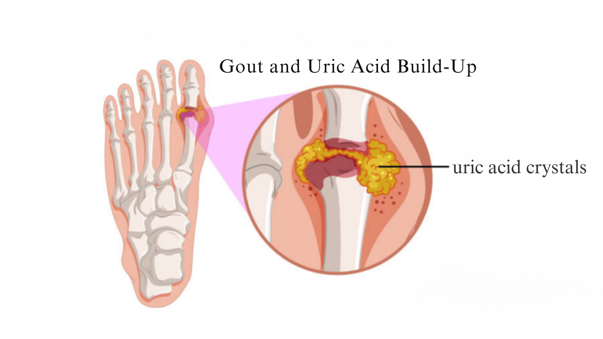 Gout-and-Uric-Acid-Build-Up