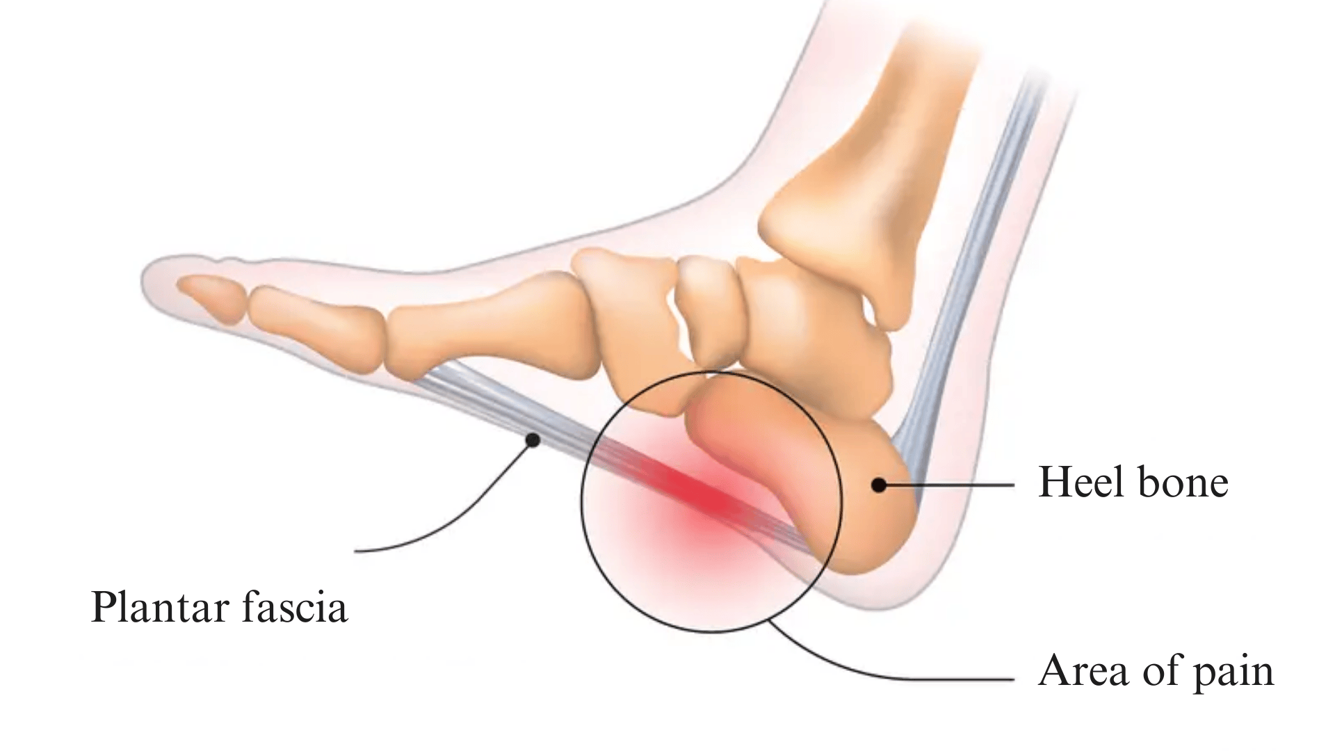 Plantar-Fasciitis-and-Heel-Pain
