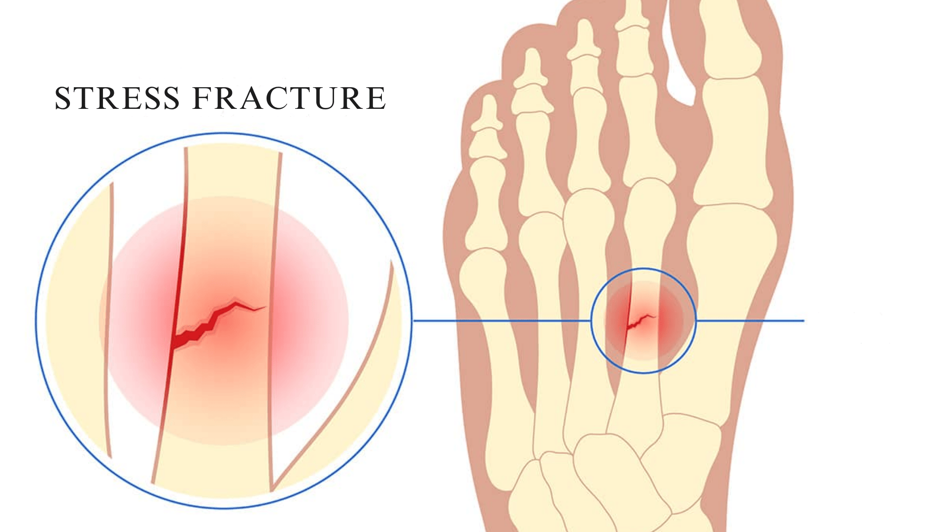 Stress-Fractures