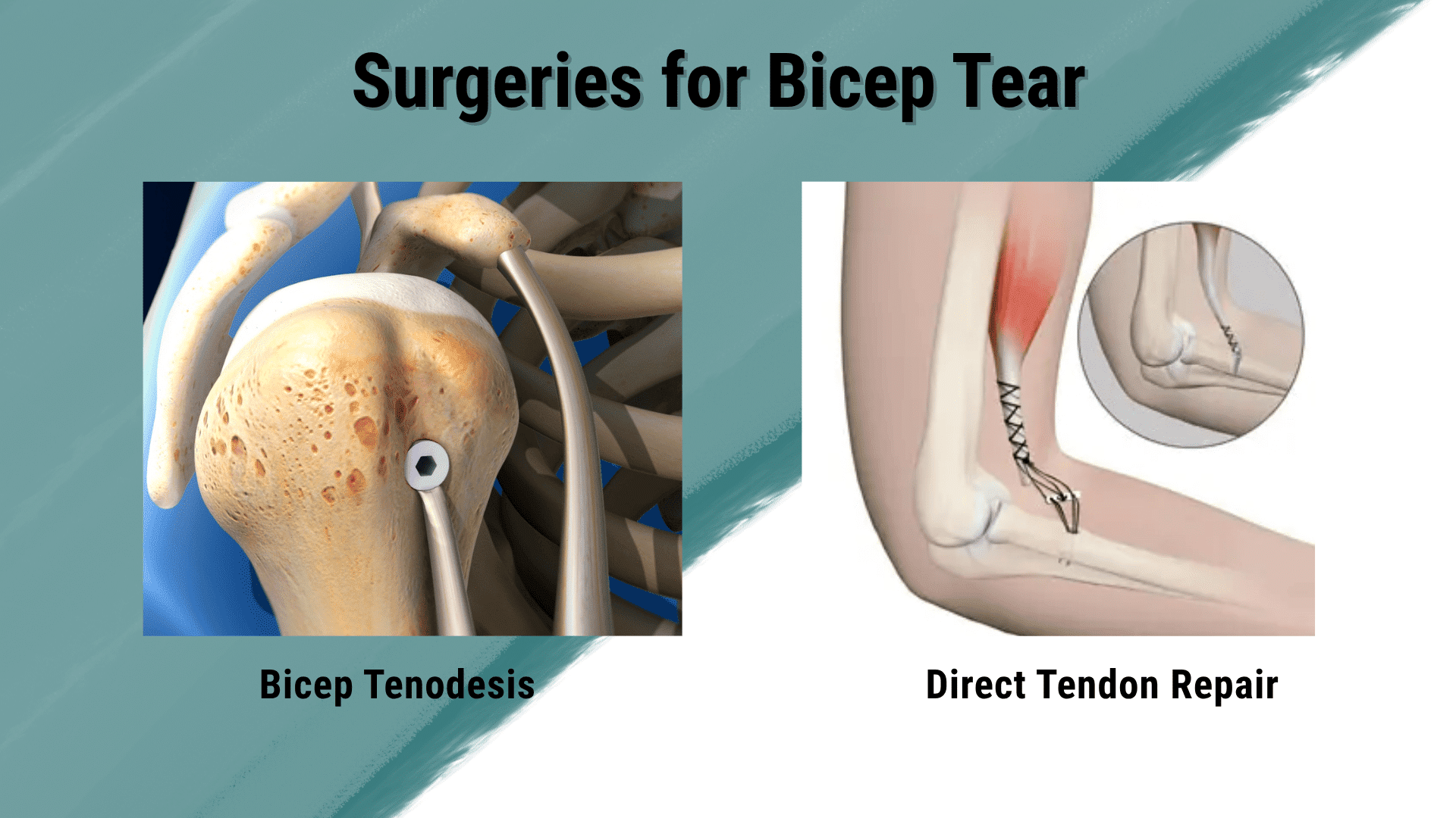 Surgical-Treatment-For-Biceps